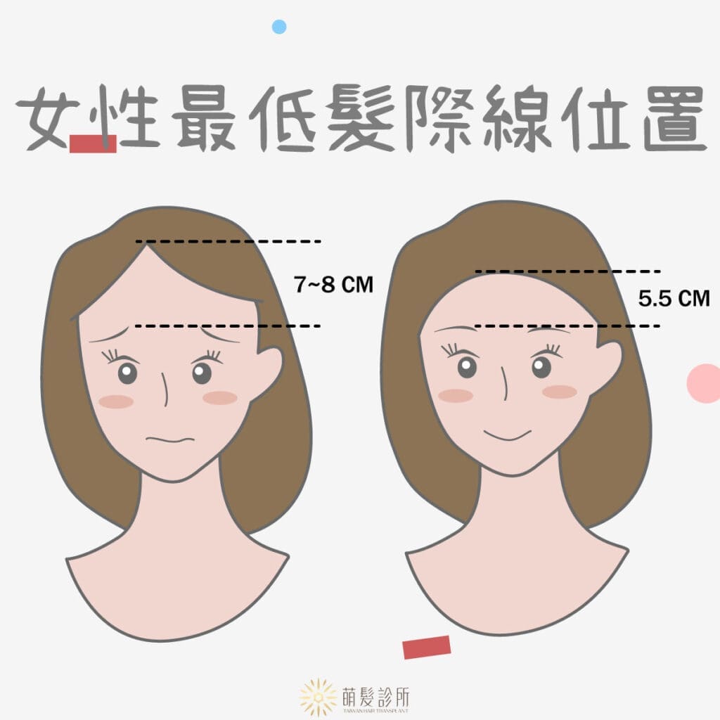 女性最低髮際線在哪裡?