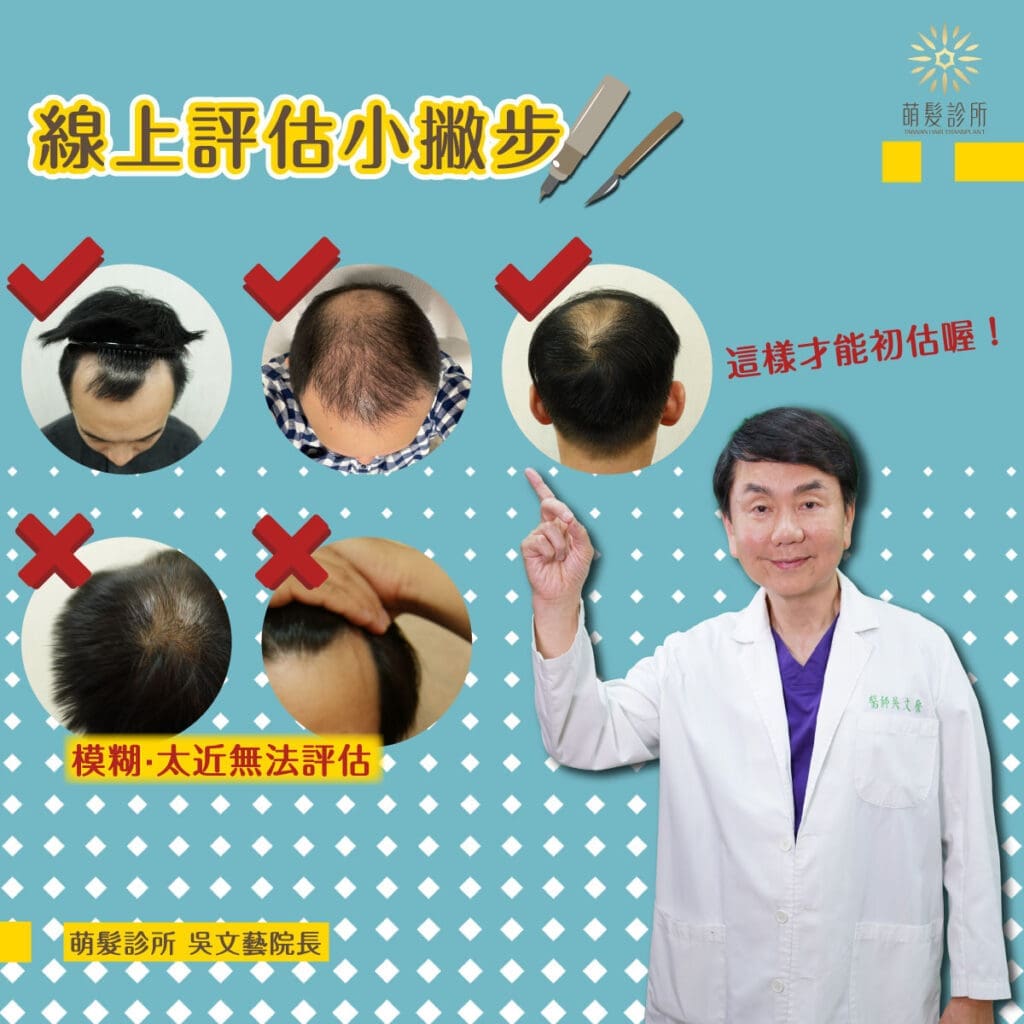 植髮線上評估諮詢小撇步!