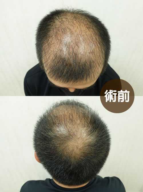 COMBO 巨量植髮案例 A