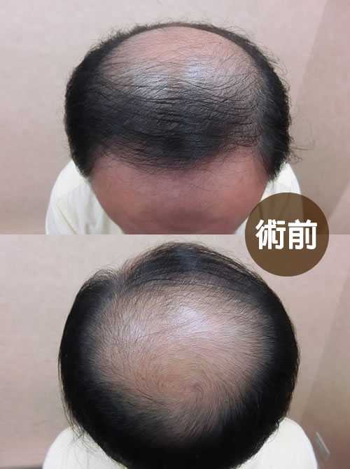 COMBO 巨量植髮案例 C