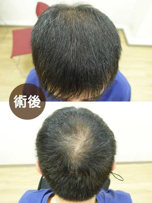 COMBO 巨量植髮案例 A