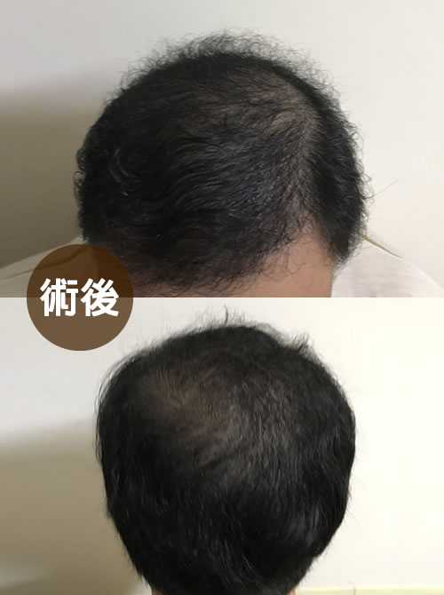 COMBO 巨量植髮案例 C